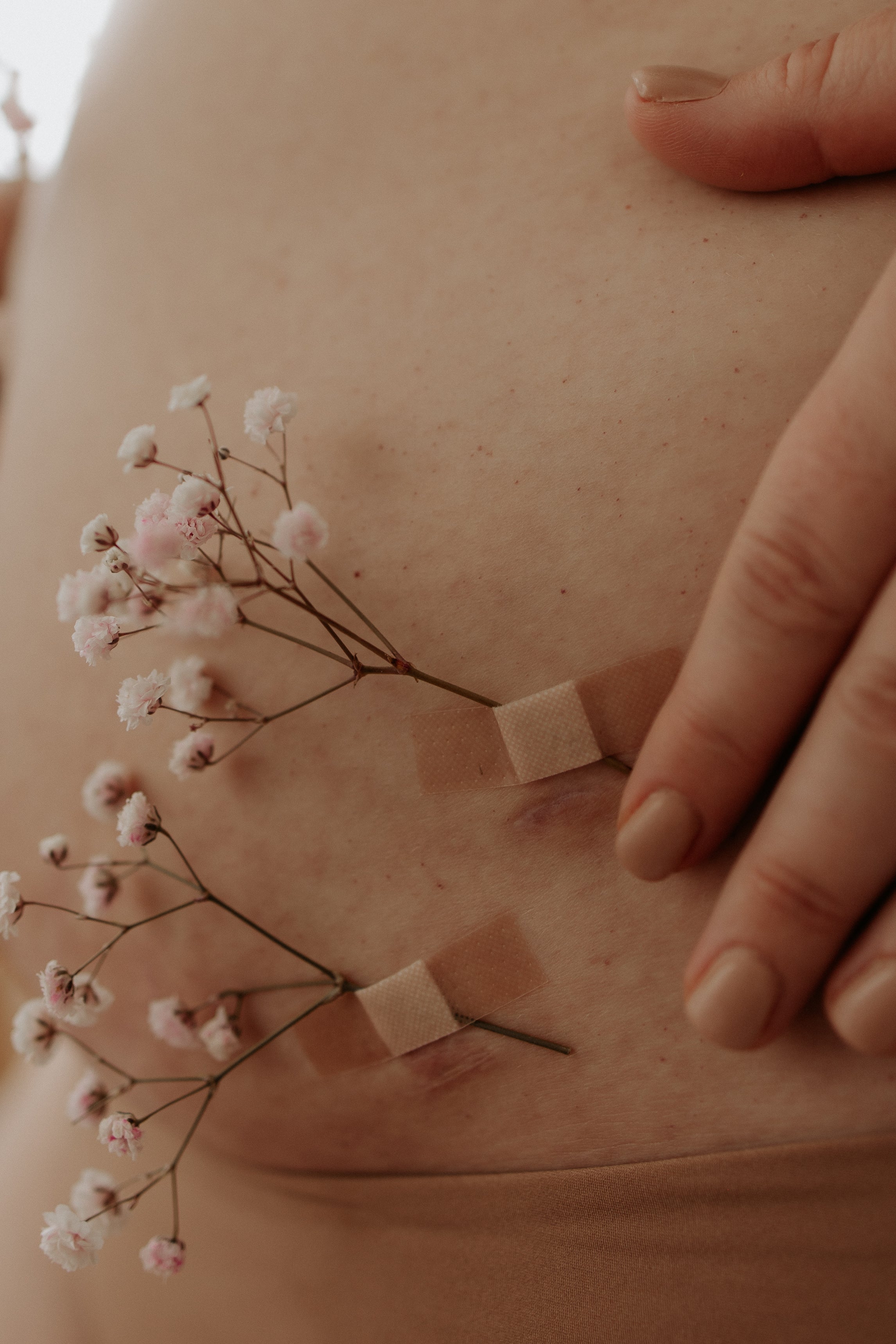 Why a Hysterectomy DOESN’T Cure Endometriosis